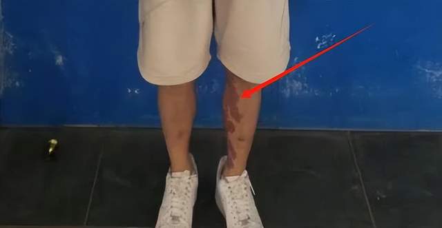 星全身照腿部伤痕惊心更多受害家属发声龙8国际唯一网站营救神速！泰方公布星(图6)